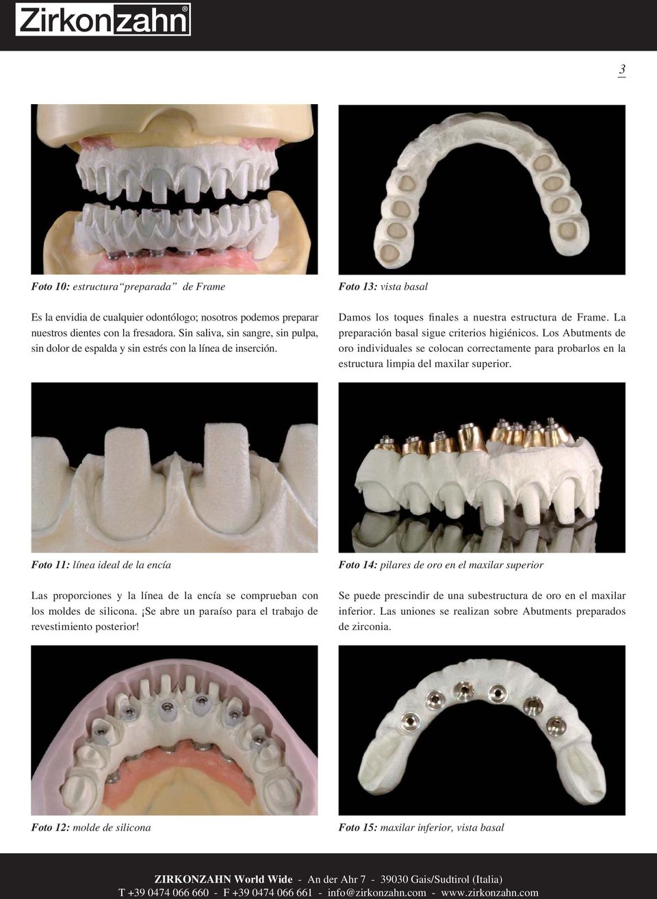 La preparación basal sigue criterios higiénicos. Los Abutments de oro individuales se colocan correctamente para probarlos en la estructura limpia del maxilar superior.