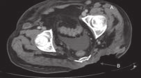 Cirugía y Cirujanos Volumen 82, No. 1, Enero-Febrero 2014 metástasis pulmonares mediastinales, hepáticas e inguinales del lado izquierdo (Figura 5 y 6).