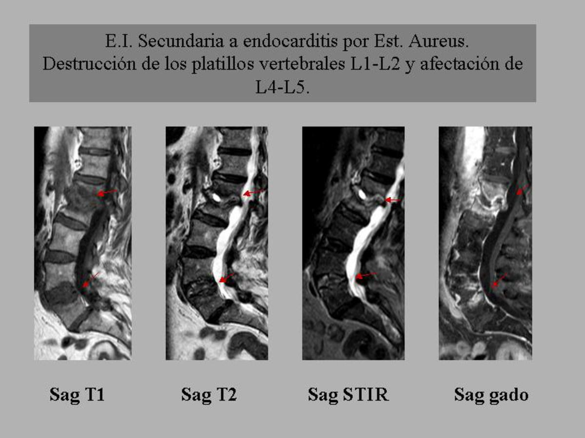 Fig. 3: Espondilodiscitis L1-L2 con afectación de la médula ósea y destrucción de los platillos vertebrales adyacentes