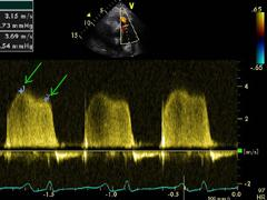 Ecocardiografía: Hipertensión Pulmonar La medición de la presión pulmonar es un componente importante del examen ecocardiográfico completo, correctamente realizado.