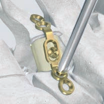 B. Laminoplastia ARCH con espaciador 4 Fijación de la miniplaca Instrumentos necesarios 311.030 Mango con anclaje dental 388.174 Broca de B 1.5 mm con tope, 388.178 de 4 a 12 mm 311.