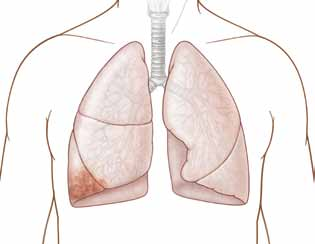 Problemas que afectan el tórax y los pulmones Los pulmones y el tórax pueden verse afectados por numerosos problemas, tales como masas tumorales, infecciones y otras enfermedades.