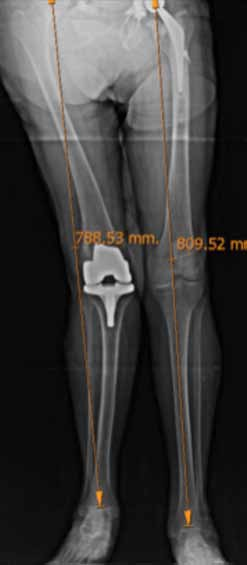 Año 79 Número 2 20 Prótesis total de rodilla en pacientes con enfermedad de Parkinson 03 y fue reducida en forma cerrada, sin consecuencias funcionales a futuro ni reluxación.