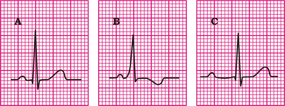 Onda P Es la primera onda del ECG, representa la contracción aurículas, es la deflexión que precede al complejo QRS, es positiva en DI, DII, avf y precordiales izquierdas, bifásica en V1 y negativa