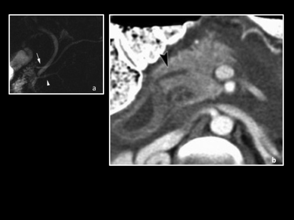 Fig. 7: Pancreas divisum. (a) Colangiopancreatografía por RM: muestra el drenaje pancreático a través del conducto de Santorini (flecha).
