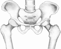 Localizaciones de las fracturas por fragilidad Fracturas vertebrales: Las fracturas vertebrales morfométricas son asintomáticas y no implican una pérdida de la calidad de vida de la paciente Las