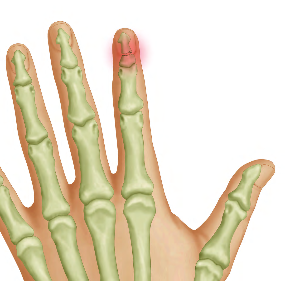 FRACTURAS Y LUXACIONES DE MANO CLÍNICA Traumatismos generalmente directos de origen laboral o deportivo, dan lugar a distintas lesiones de mano y dedos, pudiendo tener como resultado fracturas o