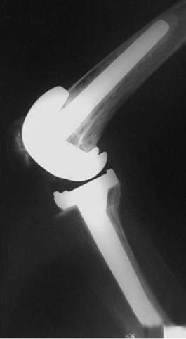 Año 75 Número 2 junio de 2010 Artroplastia total de rodilla en pacientes con artritis reumatoide 173 En cuanto a las líneas de radiolucidez < 1 mm se encontraron en las zonas 1 y 2 del componente