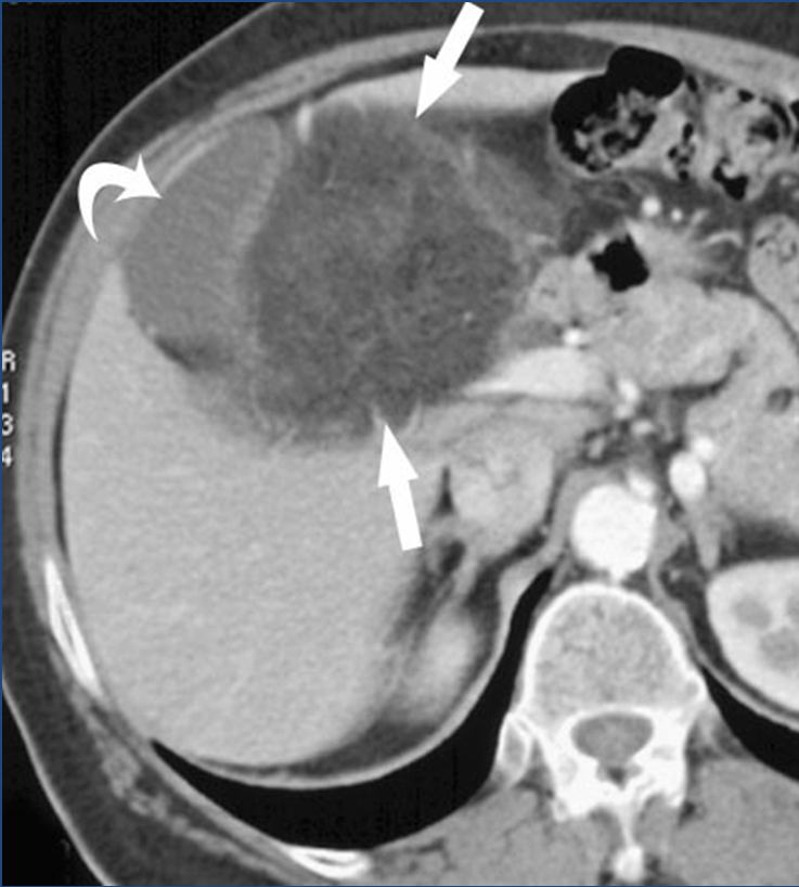Fibromatosis mesentérica en hombre de 57 años, con Enfermedad de Crohn. En la TC con contraste se observa una masa mal definida en el mesenterio.