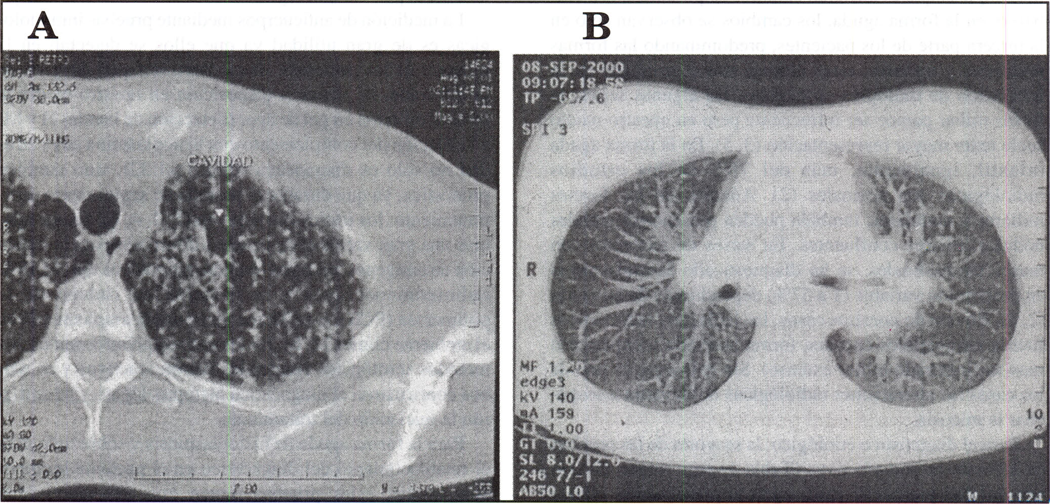 PRESENTACION DE CASOS Histoplasmosis Figura 1. Radiografías simples de tórax.