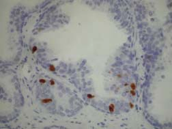 Figura 35- En la glándula normal la proliferación celular es escasa, y se observa fundamentalmente en las células basales.