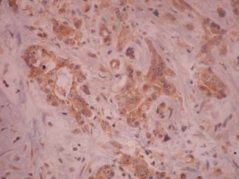 Figura 42- La inmunopositividad para Flt-1 fue mayor en algunas zonas de neoplasia intraepitelial de alto grado que en el adenocarcinoma, que