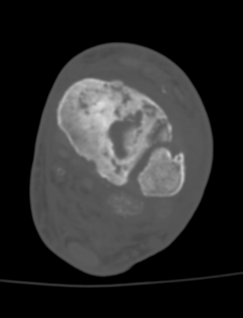 brero 2014: Diagnóstico diferencial: -osteocondromatosis sinovial -condrosarcoma
