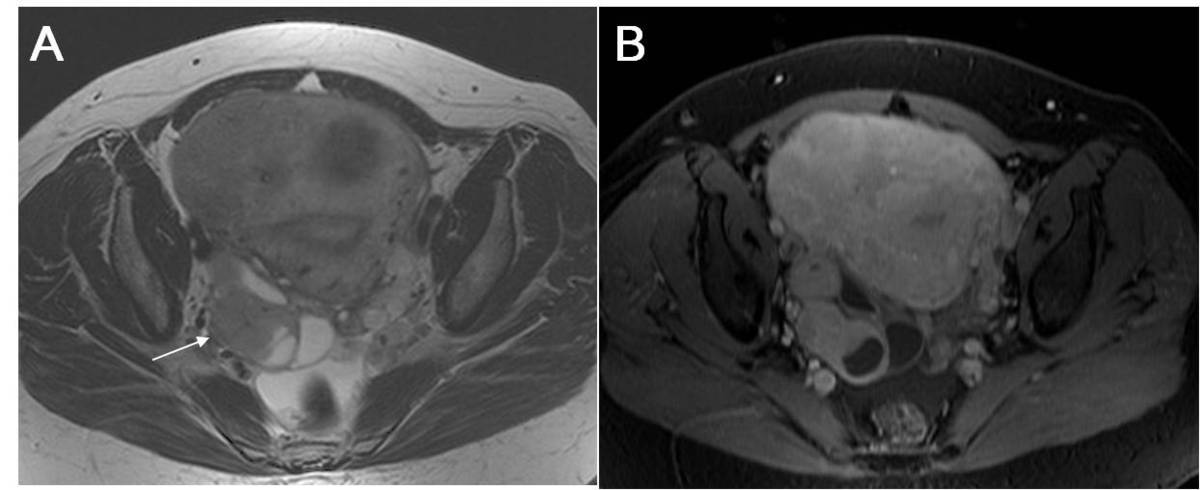 Sarcoma del estroma endometrial estadío IC. Tumor limitado al útero con infiltración superior al 50% del miometrio (Fig. 6) Fig. 6: SARCOMA DEL ESTROMA ENDOMETRIAL ESTADÍO IC.