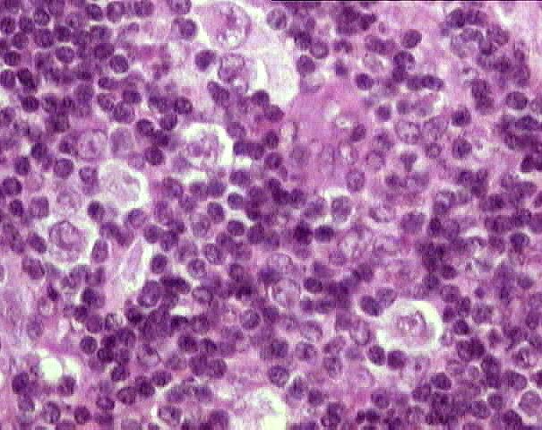 Las células Reed-Sternberg presentan forma lacunar 4 de forma frecuente en este subtipo de linfoma.