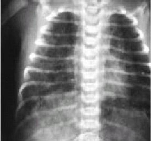 1.5.9.2. Estudios radiológicos. La radiografía de tórax típica muestra hiperinsuflación de los campos pulmonares y diafragmas aplanados.