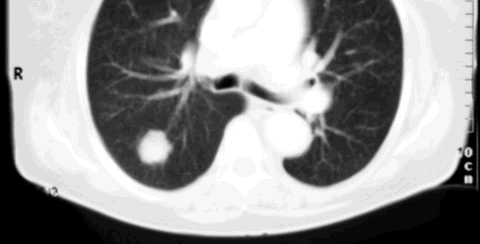 NODULO SOLITARIO Al mismo paciente se le realizó una tomografía del tórax donde se puede apreciar con mayor claridad la imagen nodular vista en la radiografia 1- Corazón