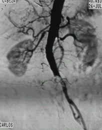 Enfermedad Arterial Arterioesclerótica tica