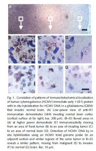 Lack of human cytomegalovirus in gliomas.