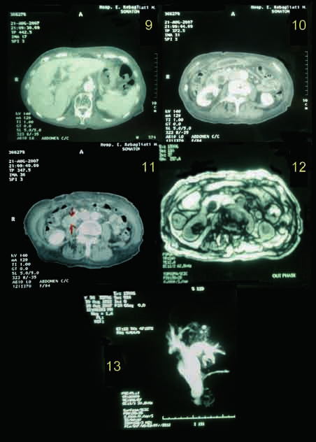 Uso racional de imágenes en pancreatitis aguda e ictericia obstructiva Foto Nº 9: corte TAC a nivel hepático que muestra imágenes hipodensas tubulares paralelas a las venas portales contrastadas que