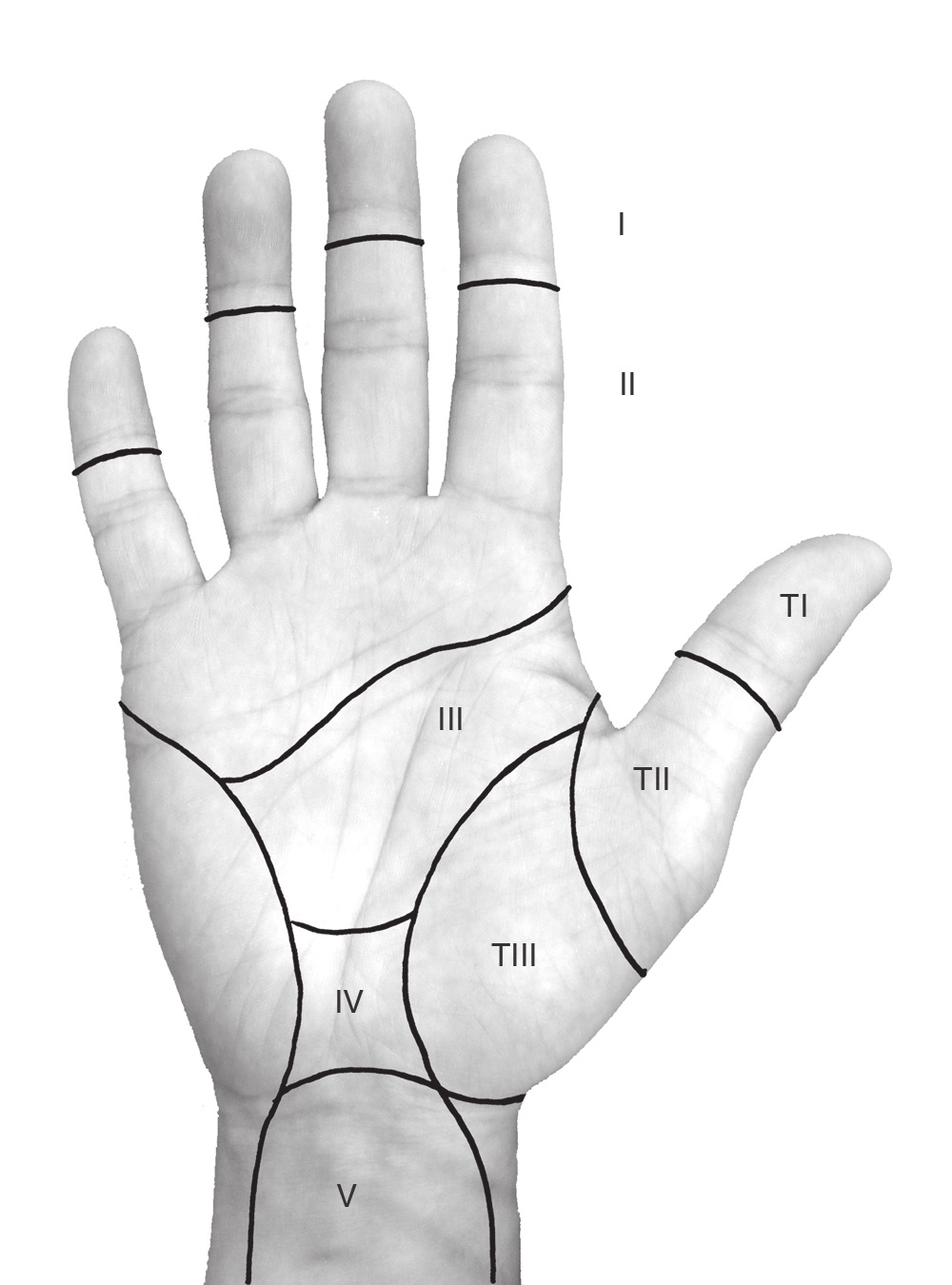 Capítulo 99: Lesiones de los tendones flexores y extensores II. Diagnóstico de las rupturas de los tendones A. Exploración de la mano lesionada 1.