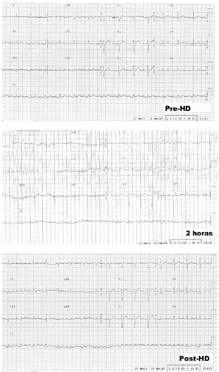 Figura 1.- Alteraciones electrocardiográficas pre-hd.