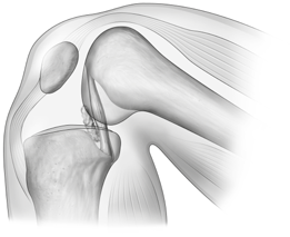 Coloque el cuerpo del resector tibial paralelo al eje longitudinal de la tibia (Figuras 6 y 7). La inclinación posterior se debe fijar marcando el grado de inclinación ajustando la leva.