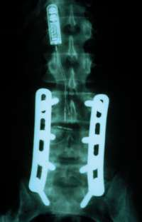 Aparatos de placas y tornillos Fracturas torácicas altas con reducción postural Fijación en pedículos o apofisis
