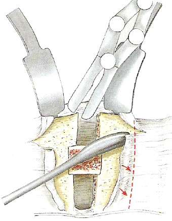 Toracotomía y Lumbotomía Técnica quirúrgica: Intubación doble lumen (Toracotomía) Posición decúbito lateral Incisión espacio superior a vértebra lesionada