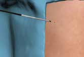 Este sistema permite suprimir uno o más trócares en los procedimientos laparoscópicos manteniendo los resultados deseados, así como mejorar