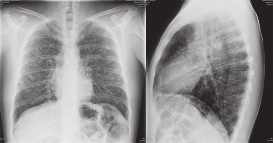 Resolución de múltiples nódulos pulmonares cavitados con el abandono del hábito tabáquico como único tratamiento 141 Introducción La histiocitosis pulmonar es una enfermedad poco frecuente, que