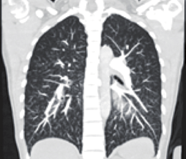 mente las paredes de las venas y en menor grado estructuras de soporte del lobulillo pulmonar