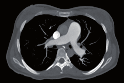 Prominencia de la arteria pulmonar principal y de sus ramas derecha e izquierda.
