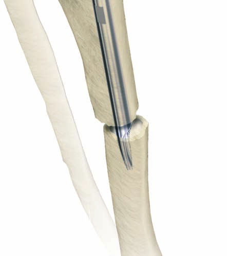 La aguja guía debe estar localizada en el centro de la metáfisis y la diáfisis en las radiografías anteroposterior y lateral para evitar una desviación del clavo tibial.