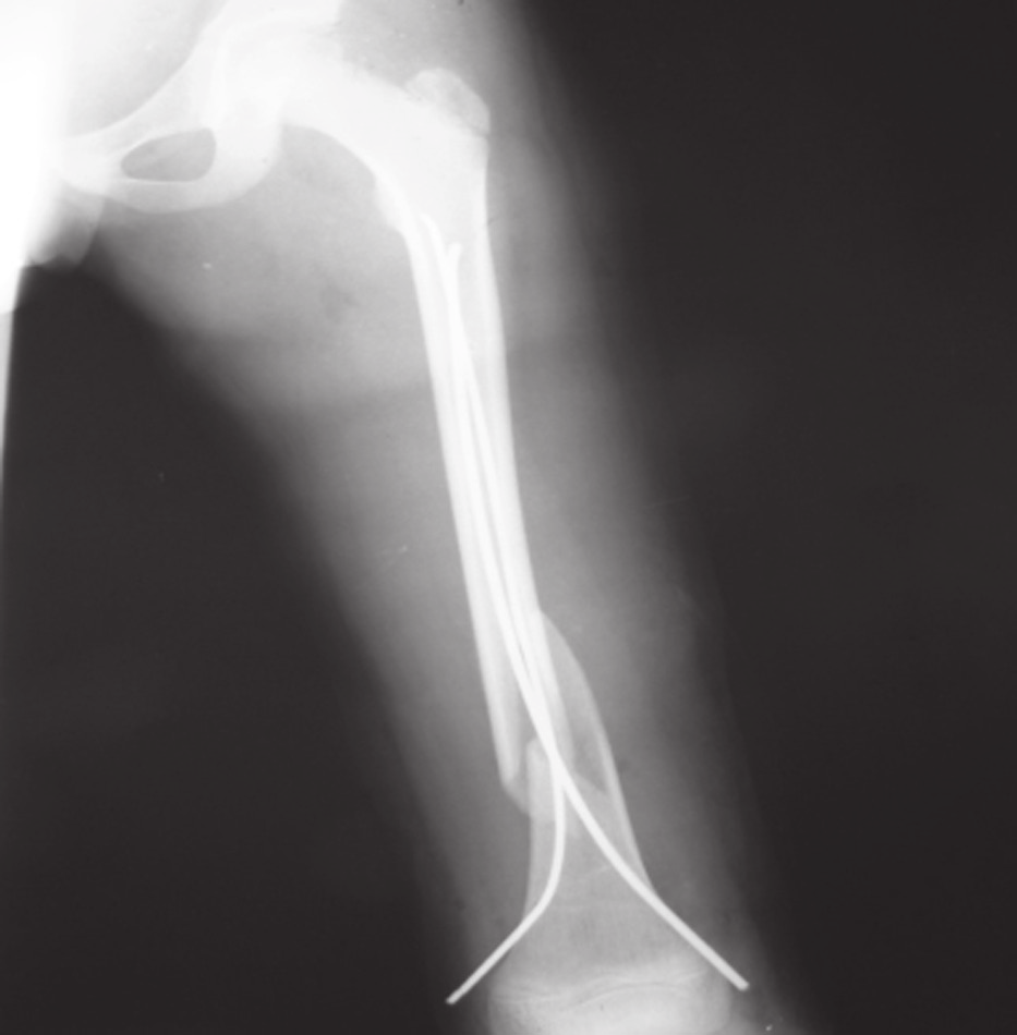 Fracturas diafisarias de fémur en pacientes pediátricos tratados con clavos flexibles de titanio Figura 2.