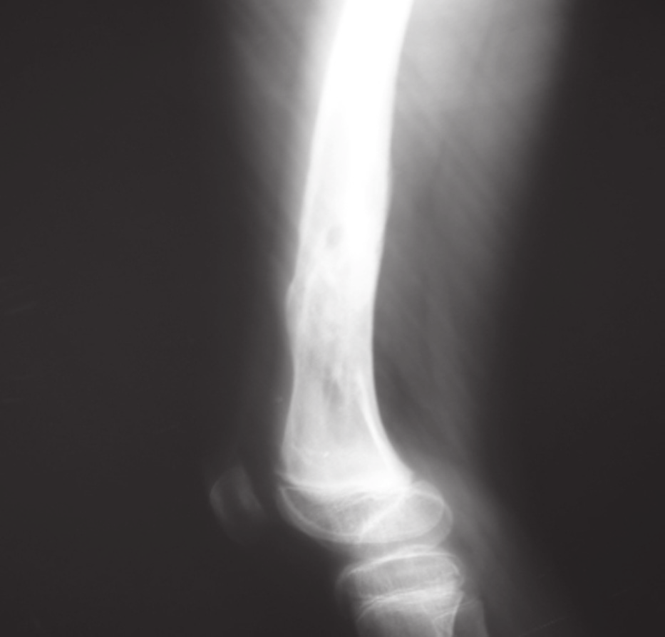pacientes se expuso un clavo en el lado externo, a nivel del sitio de colocación, y en uno de los dos pacientes hubo limitación de la movilidad en la articulación de la rodilla, movilidad que se