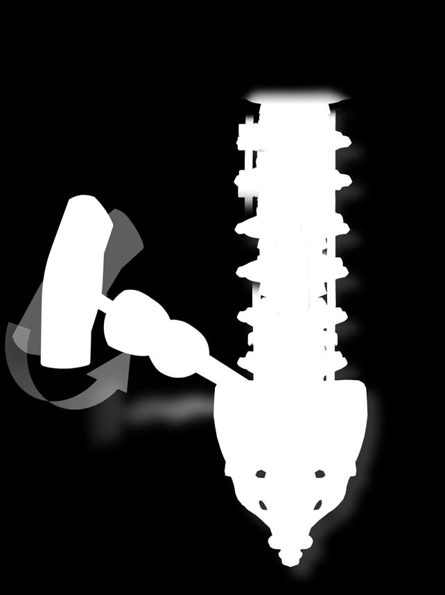 Sistema vertebral Xia Sistema toracolumbar completo Grapas Grapas anteriores de uno y dos orificios para traumas, tumores y deformaciones.