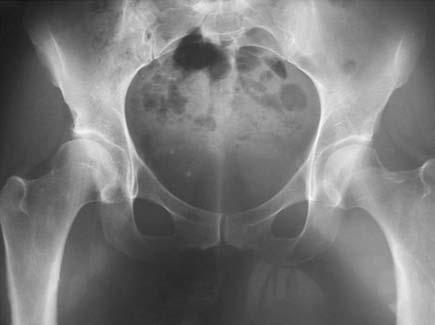 B. Osteotomía completa del pubis. C, D y E. Osteotomía en chevron supraacetabular y retroacetabular.