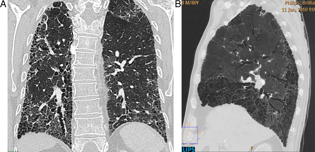 78 J. Encinas et al Figura 3 Fibrosis pulmonar idiopática con patrón típico de neumonía intersticial usual. Reconstrucciones a partir de estudio de TCAR.