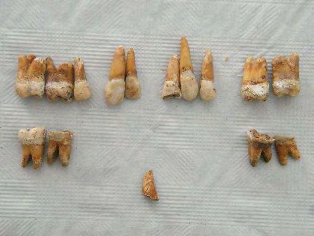 Informe de exhumación de fosa común en Casavieja (Ávila) Marzo de 2009 Estudio odontológico 47 Individuo con una edad estimada entre los 25-35 años