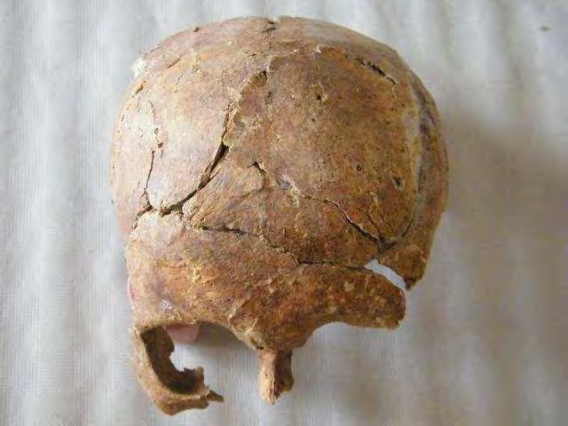 Informe de exhumación de fosa común en Casavieja (Ávila) Marzo de 2009 Estudio antropológico 53 Grado de conservación del material óseo muy deficiente.