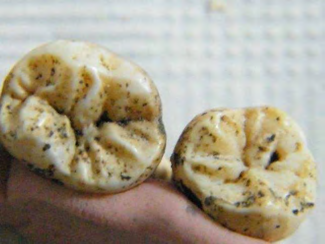 Informe de exhumación de fosa común en Casavieja (Ávila) Marzo de 2009 Estudio odontológico 64 Las piezas dentarias