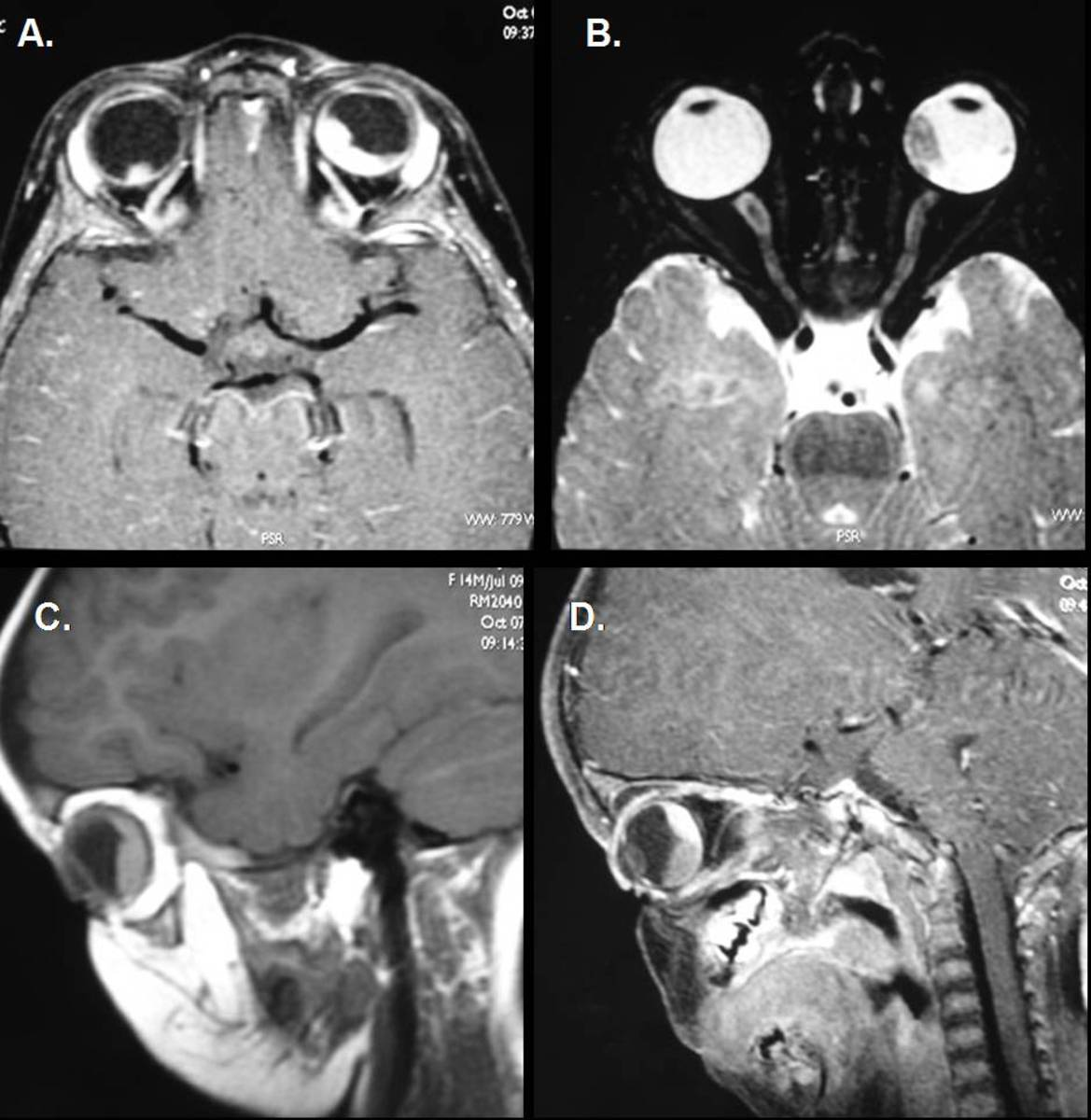 Fig. 4: Imágenes axiales de TC: A. Masa en polo posterior de órbita derecha, hiperdensa en relación con vítreo ipsilateral. B. Calcificaciones visualizadas en otro caso de Retinoblastoma. Fig. 5: A.
