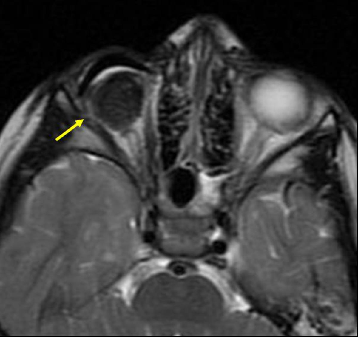 Fig. 6: Imagen RM axial T2: estudio de seguimiento, con valoración de prótesis