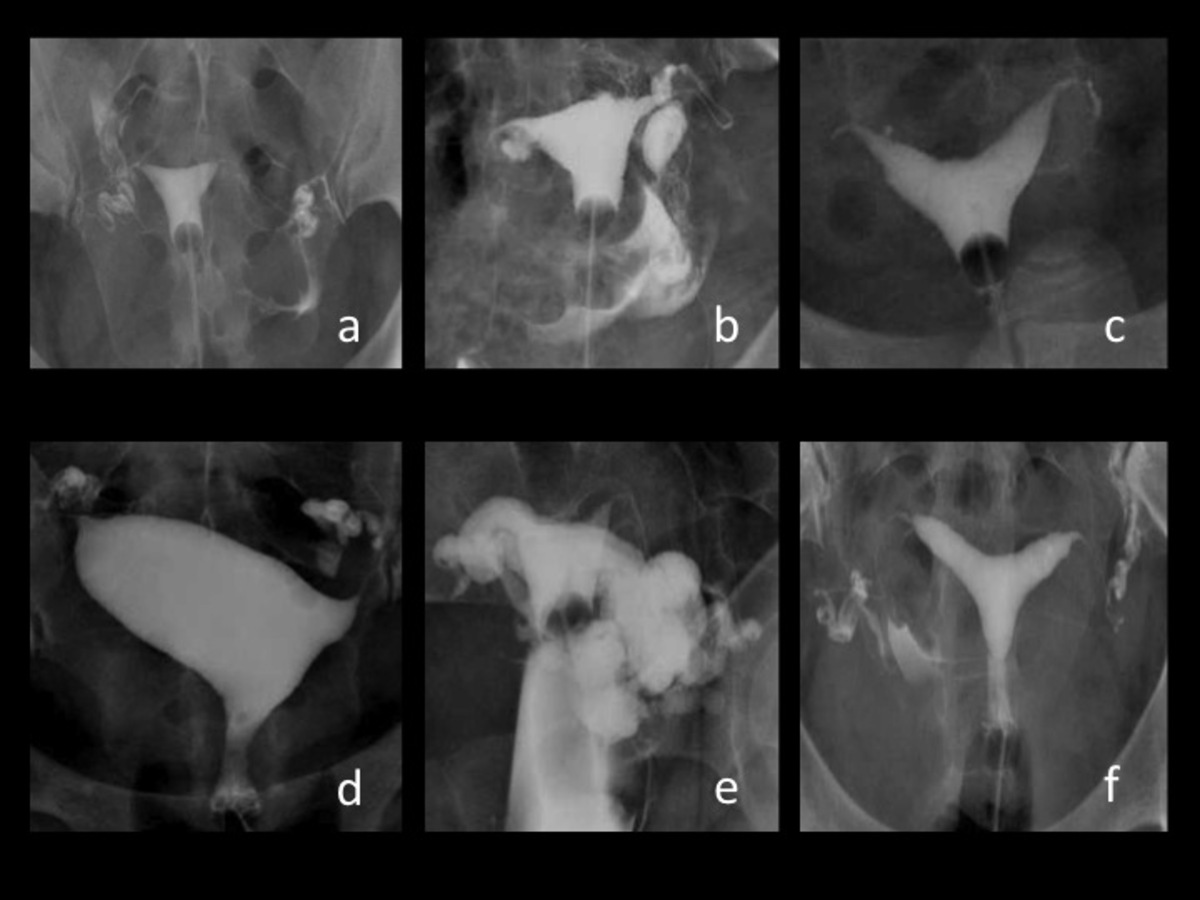 Fig. 4: a. Histerosalpingografia normal b. Divertículo uterino c.
