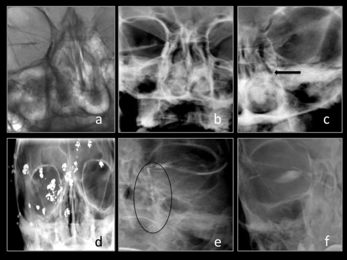 Fig. 5: a. Dacriocistografía normal b. Dacrocistografia normal c. Obstrucción conducto lagrimo-nasal d.