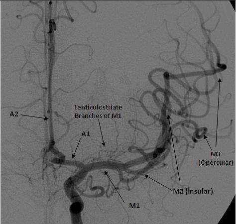 Angiograma arteria carótida interna : circulación anterior Arteria cerebral anterior = A1 : proximal A2 : distal a arteria
