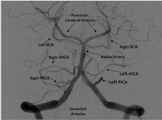 Angiograma arteria vertebral : Circulación posterior Arterias vertebrales unidas forman Arteria basilar. Arterias cerebelares posteriores inferiores (PICA) se originan de Arterias vertebrales.