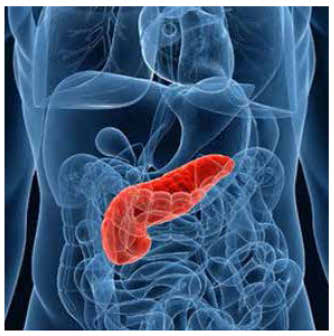 Tractament inicial pancreatitis aguda Dieta absoluta