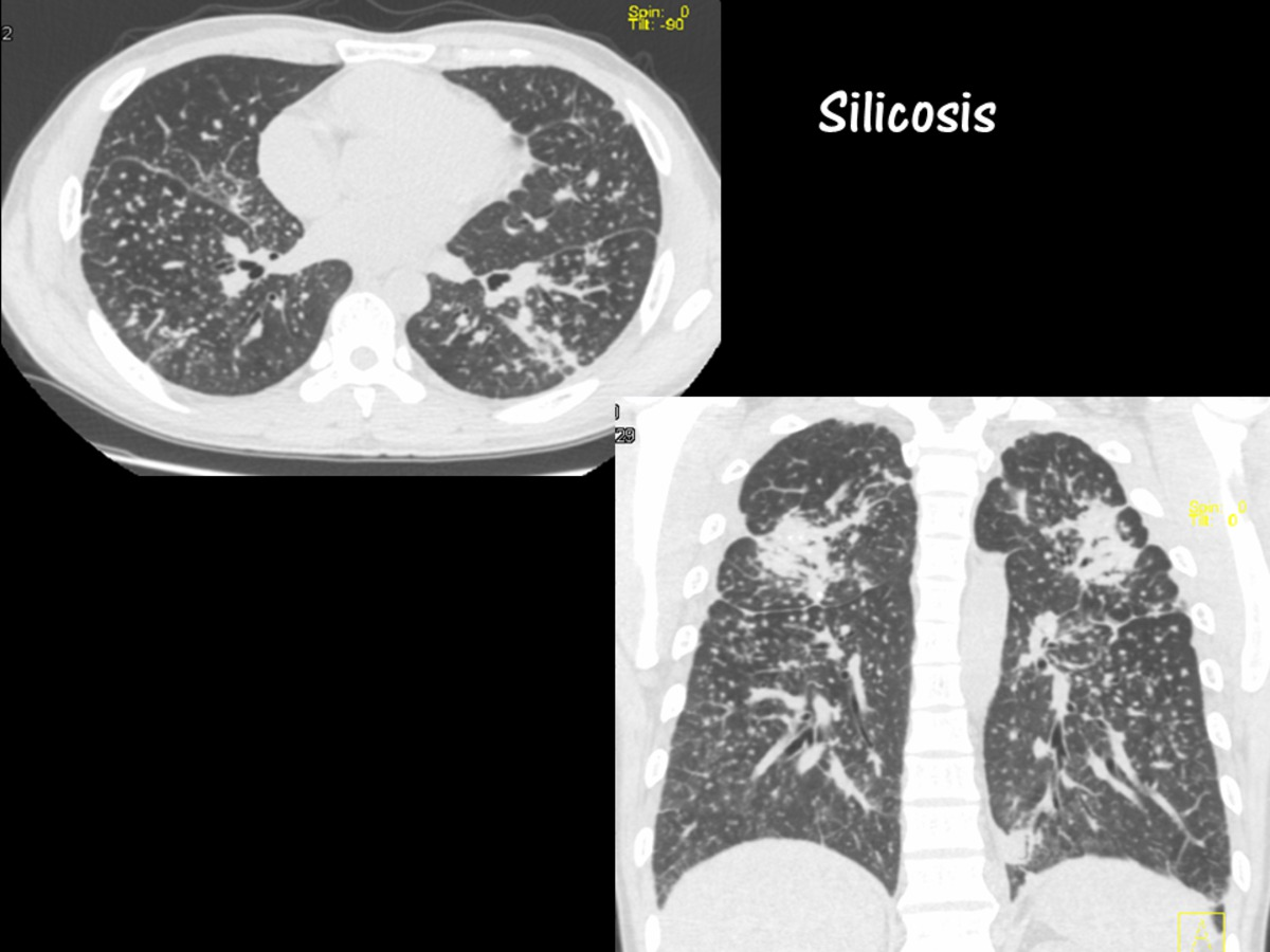 Fig. 5: Distribución nodulillar perilinfática. TC pulmón, plano axial y coronal (reconstrucción MPR), en paciente con silicosis.